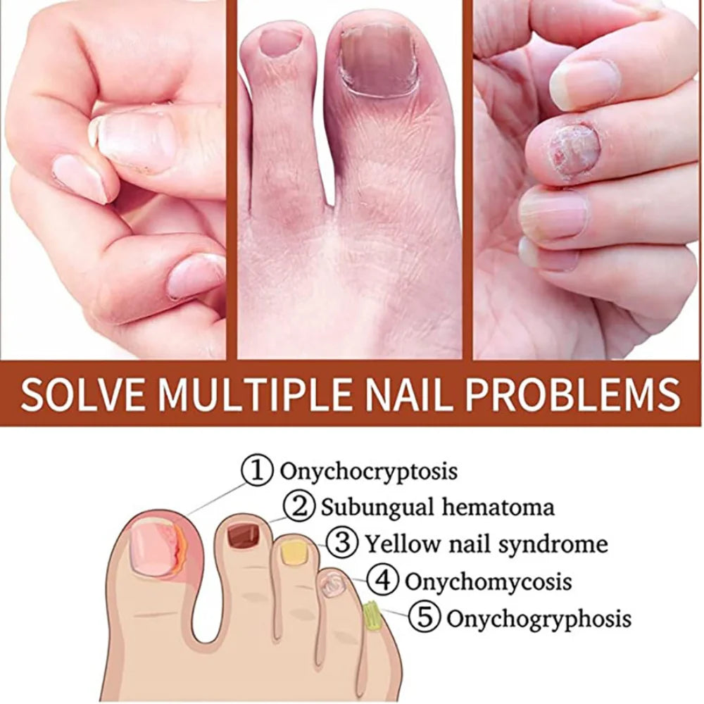 Nail Fungus Treatments Serum Anti-Infection 7DAYS Repair Foot Onychomycosis Paronychia Toe Care Nails Fungal Removal Gel  uñas